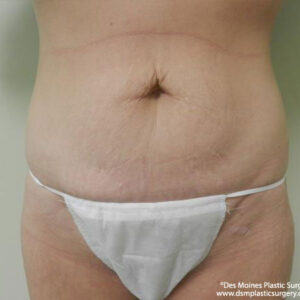 Tummy Tuck before and after photos