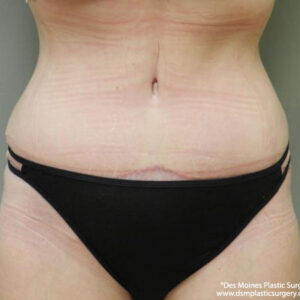 Tummy Tuck before and after photos