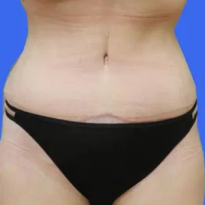 Tummy Tuck before and after photos Tummy Tuck before and after photos