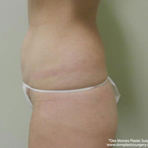 Tummy Tuck before and after photos
