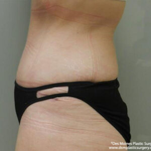 Tummy Tuck before and after photos