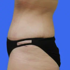 Tummy Tuck before and after photos Tummy Tuck before and after photos