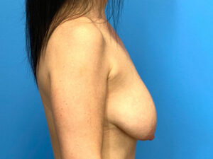 Breast Lift before and after photos