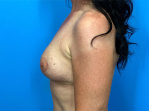 Breast Lift before and after photos