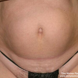 Liposuction before and after photos