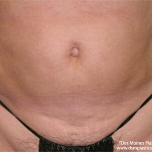 Liposuction before and after photos