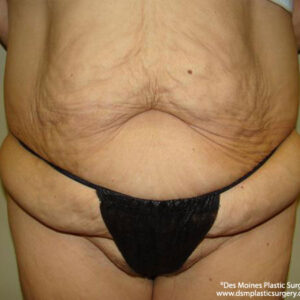 Tummy Tuck before and after photos