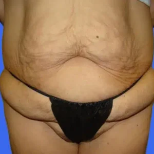 Tummy Tuck before and after photos Tummy Tuck before and after photos