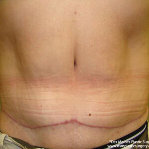 Tummy Tuck before and after photos