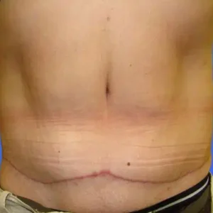Tummy Tuck before and after photos Tummy Tuck before and after photos