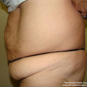 Tummy Tuck before and after photos