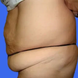 Tummy Tuck before and after photos Tummy Tuck before and after photos