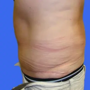 Tummy Tuck before and after photos Tummy Tuck before and after photos