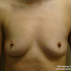 Breast Augmentation before and after photos