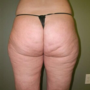 Liposuction before and after photos