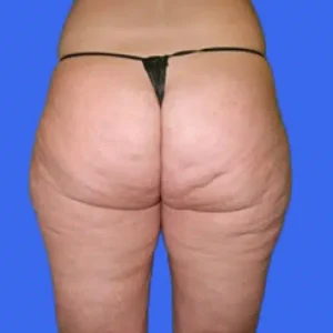 Liposuction before and after photos Liposuction before and after photos