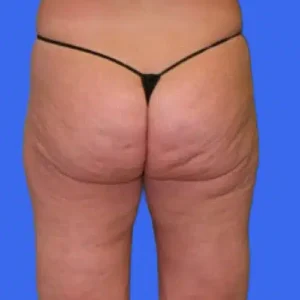 Liposuction before and after photos Liposuction before and after photos