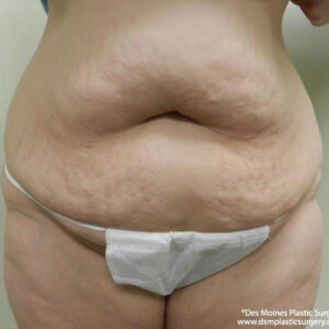 Tummy Tuck before and after photos