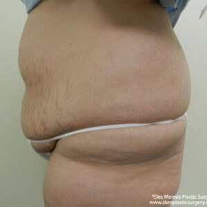 Tummy Tuck before and after photos