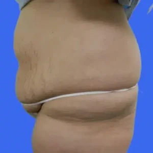 Tummy Tuck before and after photos Tummy Tuck before and after photos