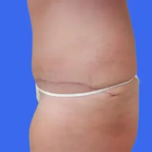 Tummy Tuck before and after photos Tummy Tuck before and after photos