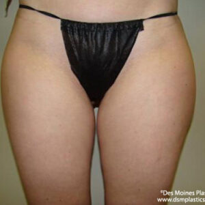 Liposuction before and after photos
