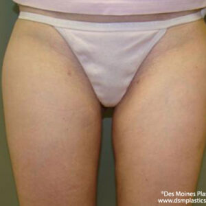 Liposuction before and after photos