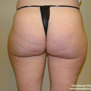 Liposuction before and after photos