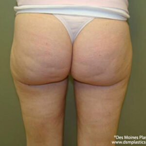 Liposuction before and after photos