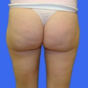 Liposuction before and after photos Liposuction before and after photos