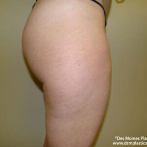 Liposuction before and after photos