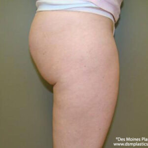 Liposuction before and after photos