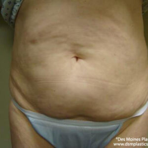 Tummy Tuck before and after photos