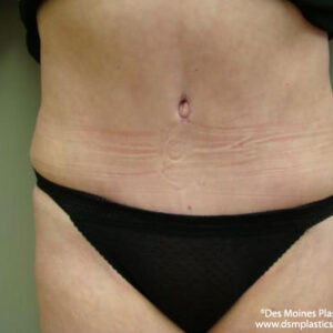 Tummy Tuck before and after photos