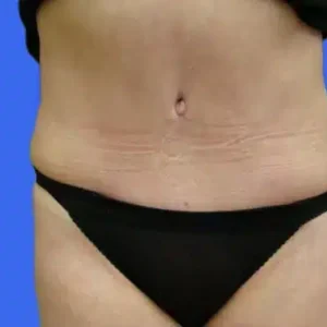 Tummy Tuck before and after photos Tummy Tuck before and after photos