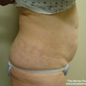Tummy Tuck before and after photos
