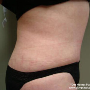 Tummy Tuck before and after photos