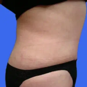 Tummy Tuck before and after photos Tummy Tuck before and after photos