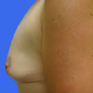 Breast Augmentation before and after photos Breast Augmentation before and after photos