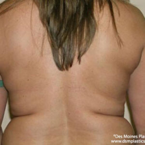 Liposuction before and after photos