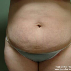 Tummy Tuck before and after photos