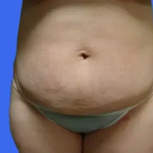 Tummy Tuck before and after photos Tummy Tuck before and after photos