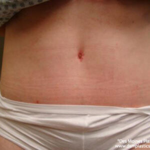 Tummy Tuck before and after photos