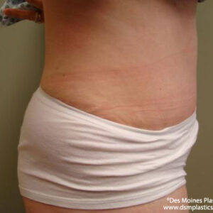 Tummy Tuck before and after photos