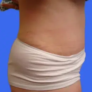 Tummy Tuck before and after photos Tummy Tuck before and after photos
