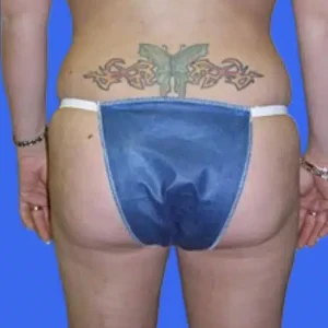 Liposuction before and after photos Liposuction before and after photos