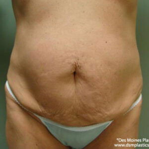 Tummy Tuck before and after photos