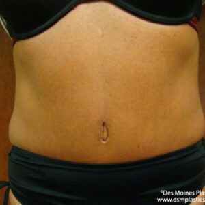 Tummy Tuck before and after photos