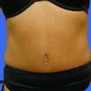Tummy Tuck before and after photos Tummy Tuck before and after photos