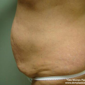 Tummy Tuck before and after photos